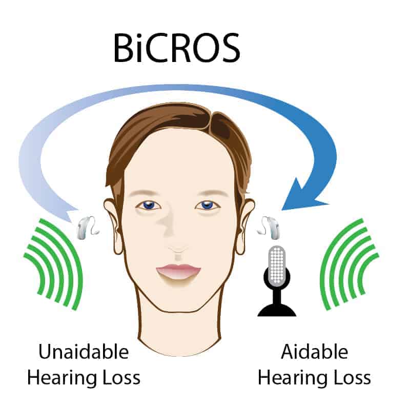 BiCROS Hearing Aid System Illustration